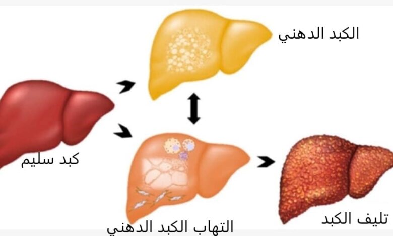 تليف الكبد