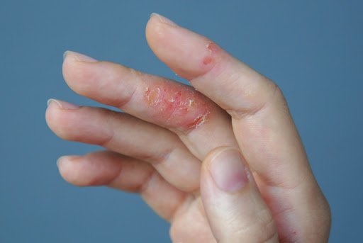 التهاب الجلد التأتبي الأسباب و الأعراض و طرق العلا