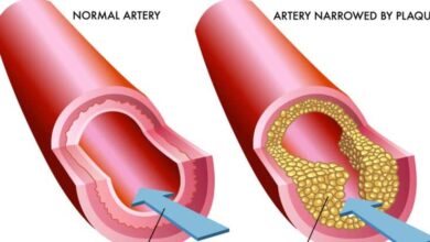 علاج تصلب الشرايين في المنزل.. إليك 8 طرق وعلاجات طبيعية