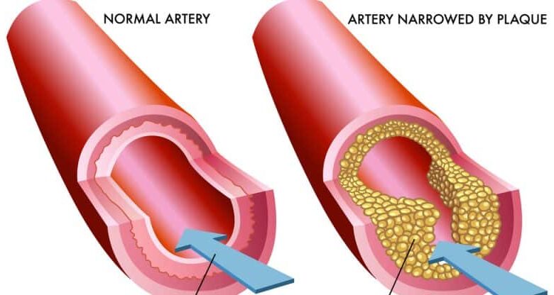 علاج تصلب الشرايين في المنزل.. إليك 8 طرق وعلاجات طبيعية