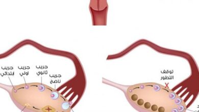 إليكِ سيدتي أبرز أعراض تضخم المبيض