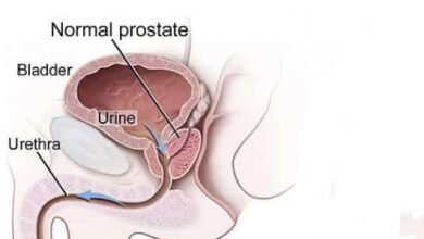 إلى الرجال هذه أهم أسباب تليف البروستاتا
