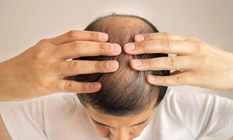 عوامل تطور زراعة الشعر في تركيا