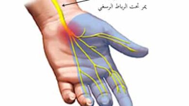 متلازمة النفق الرسغي