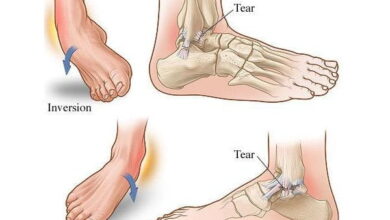 ما اهم المعلومات التي تريد معرفتها عن علاج التواء الكاحل و تمزق الاربطة؟