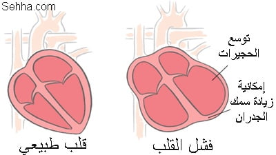 ماهو الفشل القلبي؟