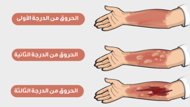 درجات الحروق