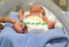 علاج ضمور المخ عند الأطفال