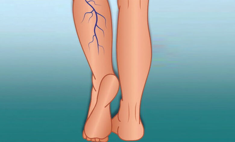تخثر الدم في الساق