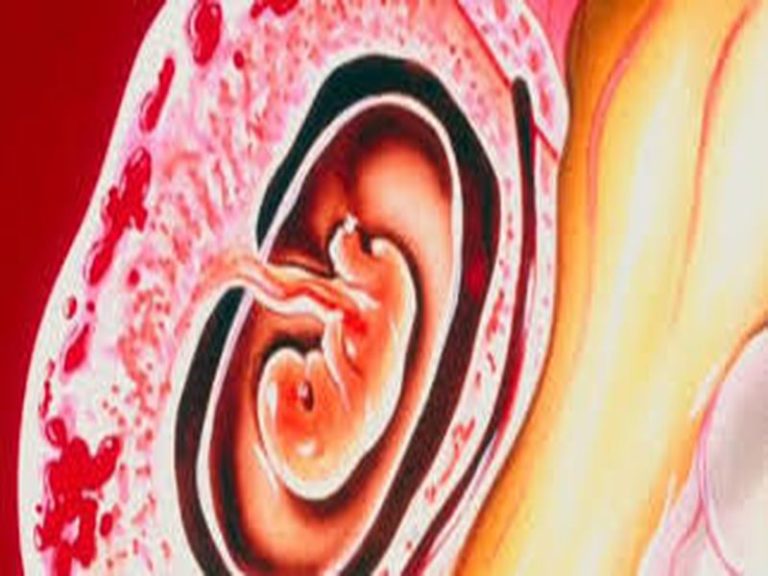 الحمل خارج الرحم الاسباب والاعراض وطرق العلاج